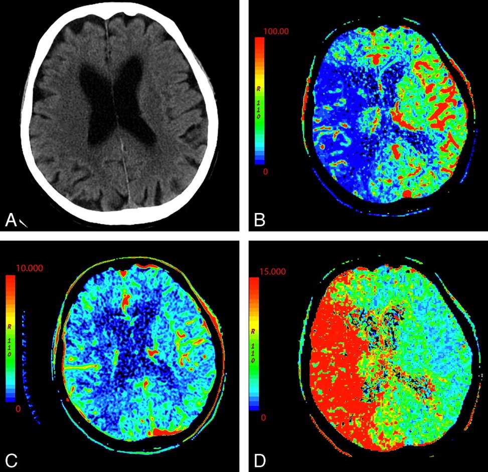 Ct Perfusion Imaging Takes Over The Scene In Acute Stroke Dimpna